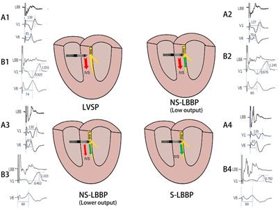 Corrigendum: Guidance on left bundle branch pacing using continuous pacing technique and changes in lead V1 characteristics under real-time monitoring